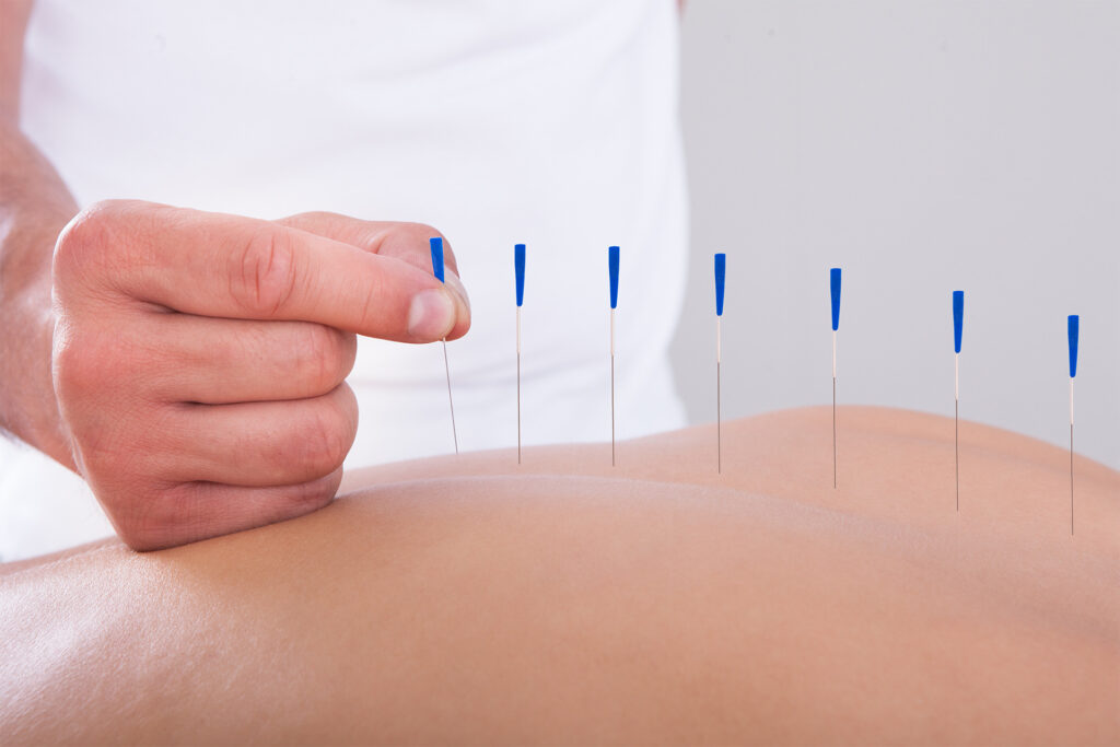 Acupuncture for Tendonitis